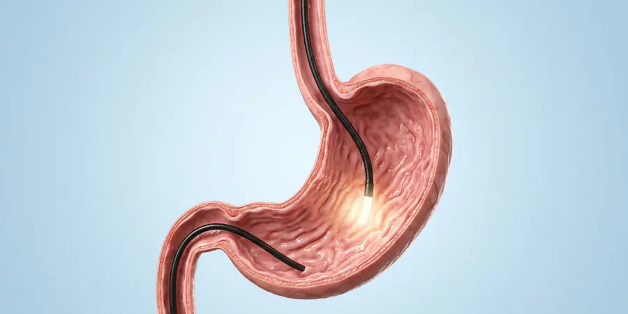 Ilustración de endoscopia digestiva alta: endoscopio dentro del esófago y el estómago
